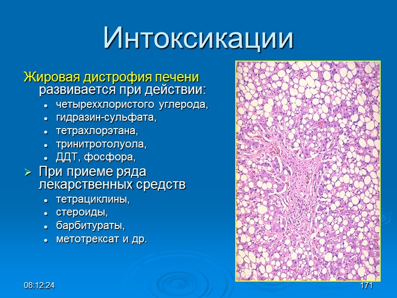 08:12:02 Интоксикации Жировая дистрофия печени развивается при действии: четыреххлористого углерода,  гидразин-сульфата,  тетрахлорэтана,
